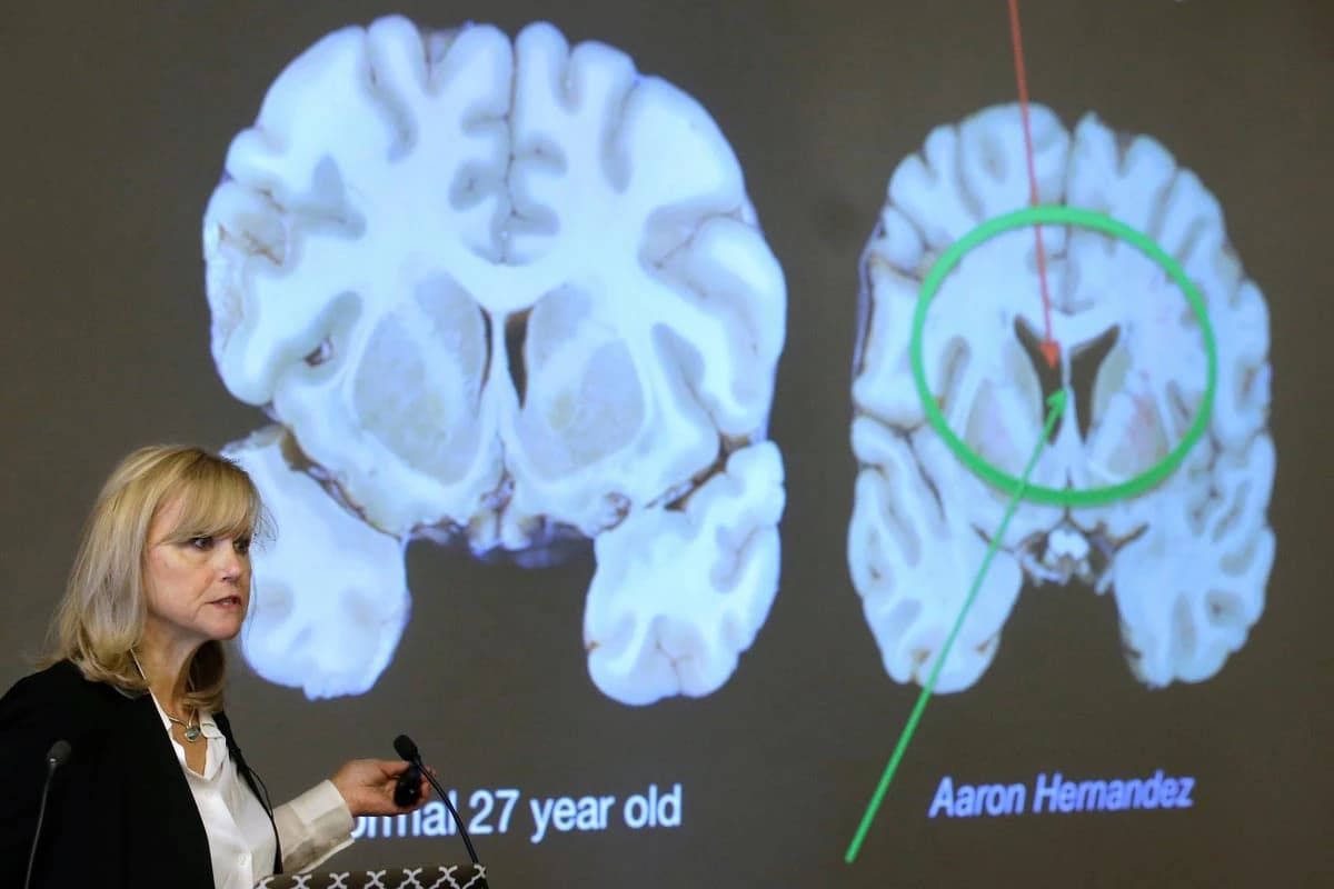 One in four NFL players could get CTE, alarming new study finds