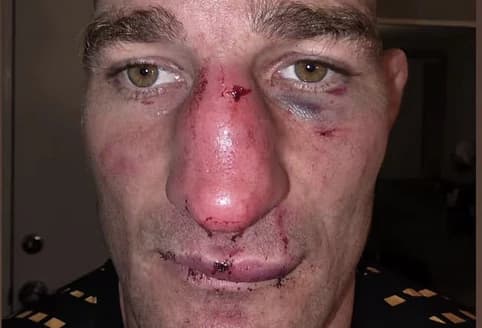 Pic: Sean Strickland shows off gruesome broken nose after UFC 328 title win